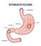 Stomach ulcer as chronic gastric problem with burning pain outline diagram