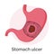 Stomach Ulcer, Gastric Illness and Problems Vector