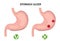 Stomach ulcer and healthy stomach infographics. Medicine concept. Vector illustration