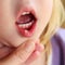 Stomatitis on lip in child