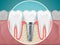 Stomatology illustrations. Dental implants and healthy teeth