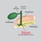 Stone pancreatic bile duct. The gall bladder, duodenum, bile ducts. Vector illustration on a gray background