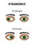 Strabismus. Esotropia. Exotropia. Infographics. Vector illustration on background.