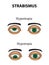 Strabismus. Hypertropia. Hypotropia. Infographics. Vector illustration on isolated background