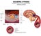 Stroke and thrombus