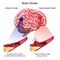 Stroke types poster, banner. Vector medical illustration. white background, anatomy image of damaged human brain