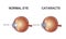 The structure of the eye. Cataract. Vector illustration