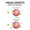 structure of the eyeball, visual impairment, near-sightedness