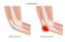 Student elbow bursitis