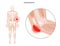 Student elbow bursitis