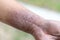 Study of physical of Atopic dermatitis AD, also known as atopic eczema, is a type of inflammation of the skin dermatitis.