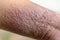 Study of physical of Atopic dermatitis AD, also known as atopic eczema, is a type of inflammation of the skin dermatitis.