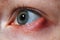 Stye on the girl`s eye, inflammation of the hair bulb on the eyelids, hordeolum, bacterial infection of an oil grand