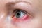 Stye on the girl`s eye, inflammation of the hair bulb on the eyelids, hordeolum, bacterial infection of an oil grand