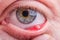 Stye hordeolum disease on eye of a caucasian female