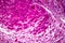 Subacute severe hepatitis, light micrograph