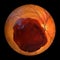 A subretinal hemorrhage as observed during ophthalmoscopy, 3D illustration