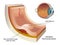 Subretinal neovascularization