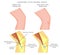 Subsartorial or pes anserine bursitis of the knee