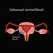 Subserous uterine fibroids. Endometriosis. Infographics. Vector illustration on a black background