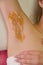 Sugaring epilation