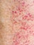 Sun adverse reaction, allergy, red rash on legs. Detail closeup.