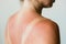 Sunburn marks on a woman`s back