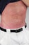 Sunburned Abdomen Man