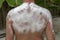 Sunburned man with cooling foam on her back. Man got sunburn and tan on her shoulder. Skin care concept