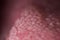 Super macro surface of tongue candidiasis overgrowth