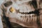 Supercomplete teeth. x-ray