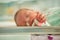 Supernumerary finger, Polydactyly case of newborn portrait