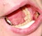 Supernumerary tooth