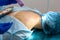 The surgeon does surgery to remove the mole on the patient`s back. The process of burning moles in a private clinic to remove