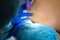 The surgeon does surgery to remove the mole on the patient`s back. The process of burning moles in a private clinic to remove