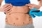 Surgeon Hands Drawing Correction Lines On Stomach