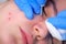 Surgeon removing mole using laser on woman face, burning skin, beauty treatment.