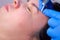 Surgeon removing mole using laser on woman face, burning skin, beauty treatment.