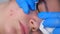 Surgeon removing mole using laser on woman face, burning skin, beauty treatment.