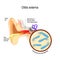 Swimmer`s ear. Otitis externa