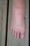 Swollen inflamed foot of a man from insect sting