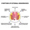 Symptoms of external hemorrhoids. The hemorrhoidal node in the rectum, anus. Infographics. Vector illustration