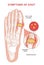Symptoms of gout infographic scheme vector flat human foot with crystallization of uric acid