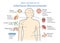 Symptoms of Infectious Mononucleosis disease.