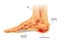 Symptoms of plantar fasciitis