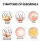 Symptoms of seborrhea. Seborrhea skin and hair. Dandruff, seborrheic dermatitis. Baldness, hair growth, baldness