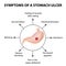 Symptoms of a stomach ulcer. Infographics. Vector illustration on background