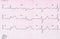 Tape ECG with acute period of myocardial infarction