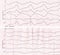 Tape ECG with idioventricular rhythm (dying heart)