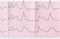 Tape ECG with macrofocal myocardial infarction and ventricular b